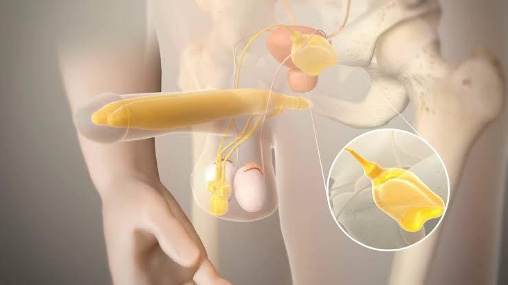 Imagem tipo raixo x representando o procedimento após o implante peniano no paciente, onde sao inseridos 2 astes inflaveis no penis, interligando outra parte onde se infla no sacro escrotal